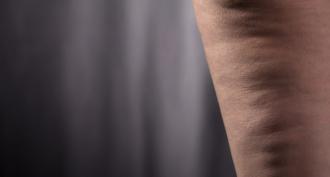 Cellulite from coffee: truth or myth?