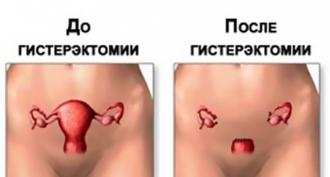 Laparoscopic method for removing uterine fibroids Laparoscopic removal of the uterus