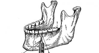 Лечение переломов нижней челюсти с применением фиксирующих аппаратов Ортопедическое лечение переломов нижней челюстей