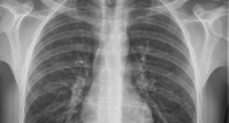 X-ray examination of the thoracic spine